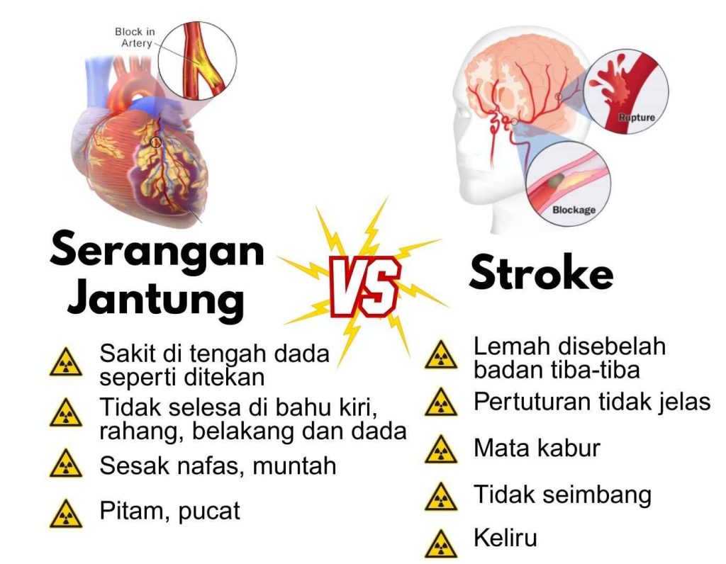 Heart attack illustration showing blocked artery and symptoms.