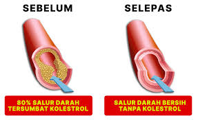 Healthy and cleaned arteries showing improved blood flow after treatment.